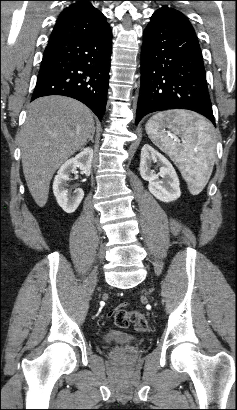 Coarctation of the aorta (Radiopaedia 74632-88521 B 164).jpg
