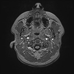Cochlear incomplete partition type III associated with hypothalamic hamartoma (Radiopaedia 88756-105498 Axial T1 20).jpg