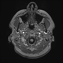 File:Cochlear incomplete partition type III associated with hypothalamic hamartoma (Radiopaedia 88756-105498 Axial T1 28).jpg
