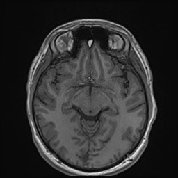 File:Cochlear incomplete partition type III associated with hypothalamic hamartoma (Radiopaedia 88756-105498 Axial T1 93).jpg