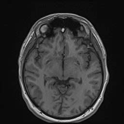 Cochlear incomplete partition type III associated with hypothalamic hamartoma (Radiopaedia 88756-105498 Axial T1 96).jpg