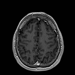 File:Cochlear incomplete partition type III associated with hypothalamic hamartoma (Radiopaedia 88756-105498 Axial T1 C+ 148).jpg