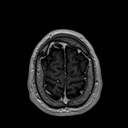 File:Cochlear incomplete partition type III associated with hypothalamic hamartoma (Radiopaedia 88756-105498 Axial T1 C+ 171).jpg
