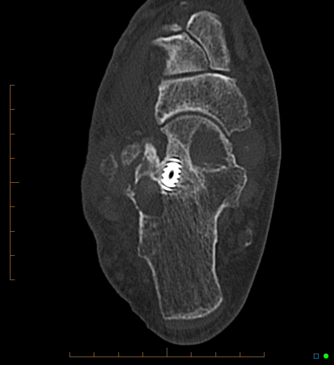Collapsed total ankle replacement (Radiopaedia 17228-16932 Axial bone window 51).jpg