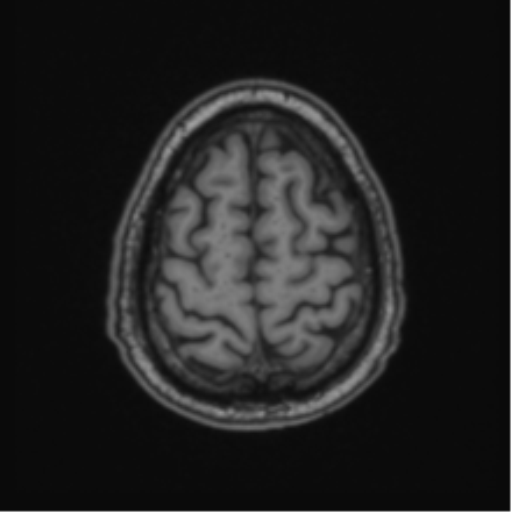 File:Colloid cyst of the third ventricle (Radiopaedia 86571-102662 Axial T1 66).png