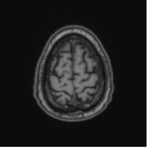 File:Colloid cyst of the third ventricle (Radiopaedia 86571-102662 Axial T1 68).png