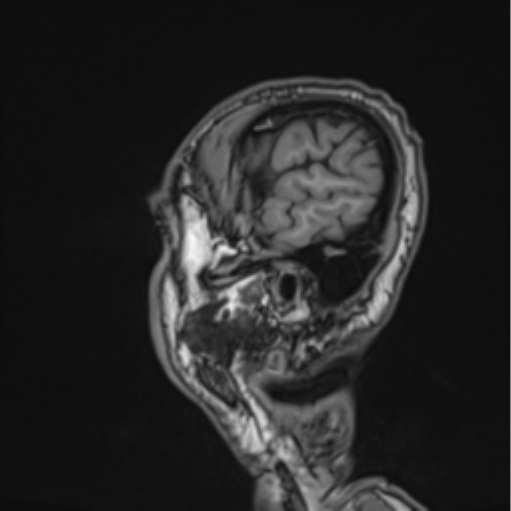 File:Colloid cyst of the third ventricle (Radiopaedia 86571-102662 Sagittal T1 9).png