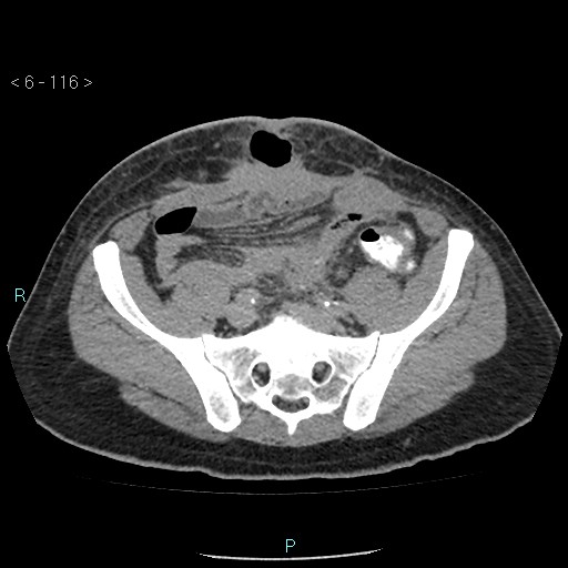 File:Colo-cutaneous fistula (Radiopaedia 40531-43129 A 48).jpg
