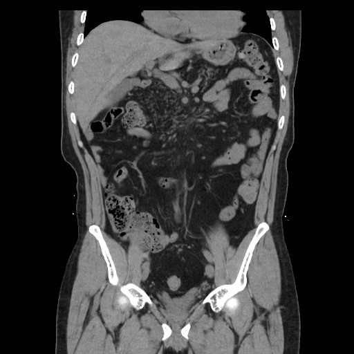 File:Colocutaneous fistula in Crohn's disease (Radiopaedia 29586-30093 Coronal non-contrast 12).jpg