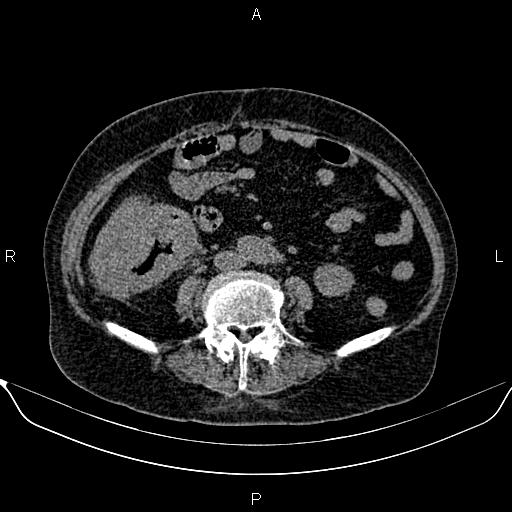 File:Colon cancer (Radiopaedia 90215-107432 Axial non-contrast 55).jpg