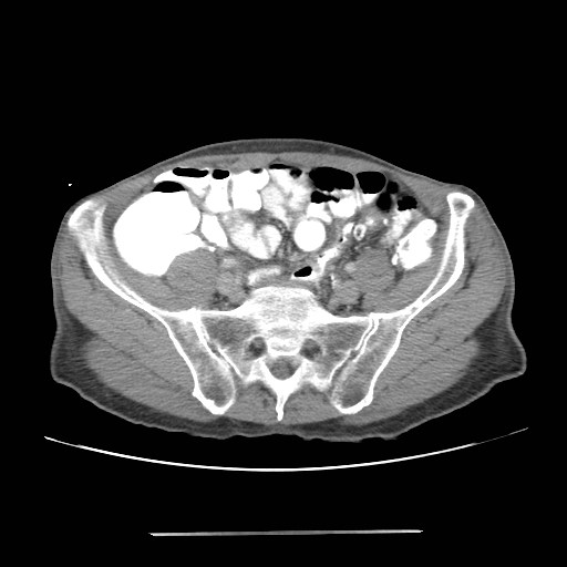 File:Colon cancer with calcified liver metastasis (Radiopaedia 74423-85307 A 57).jpg