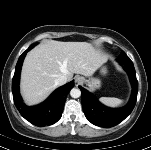 Colon carcinoma with hepatic metastases (Radiopaedia 29477-29961 A 15).jpg