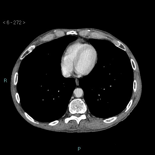 Colonic cancer (ultrasound and TC imaging) (Radiopaedia 50346-55713 B 272).jpg