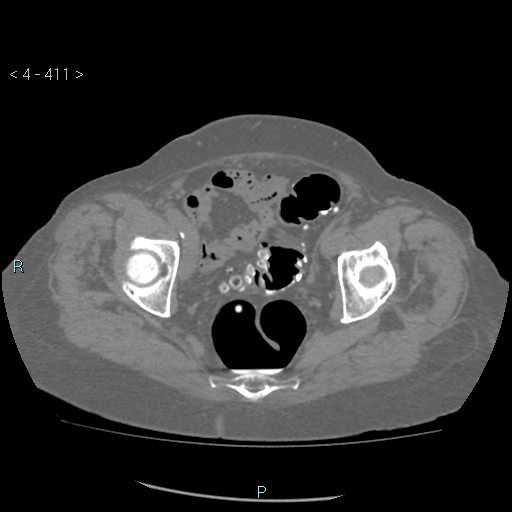 Colonic lipomas (Radiopaedia 49137-54244 Axial bone window 183).jpg