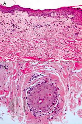 File:Figure 2 (DermNet NZ pathology-e-gvhd-figure-2).jpg