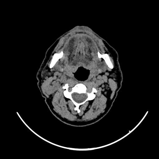 File:Nasopharyngeal carcinoma - infiltrating the clivus (Radiopaedia 62583-70875 Axial non-contrast 34).jpg