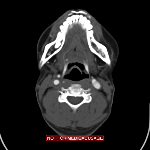 File:Nasopharyngeal carcinoma recurrence - skull base destruction (Radiopaedia 29107-29491 A 21).jpg