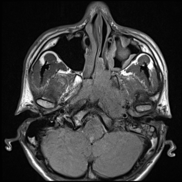 Nasopharyngeal carcinoma with skull base invasion (Radiopaedia 53415-59485 Axial T1 25).jpg