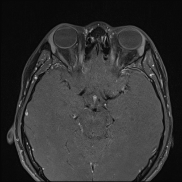 Nasopharyngeal carcinoma with skull base invasion (Radiopaedia 53415-59485 Axial T1 C+ fat sat 14).jpg