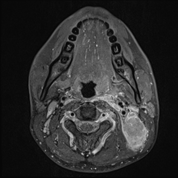 Nasopharyngeal carcinoma with skull base invasion (Radiopaedia 53415-59485 Axial T1 C+ fat sat 42).jpg