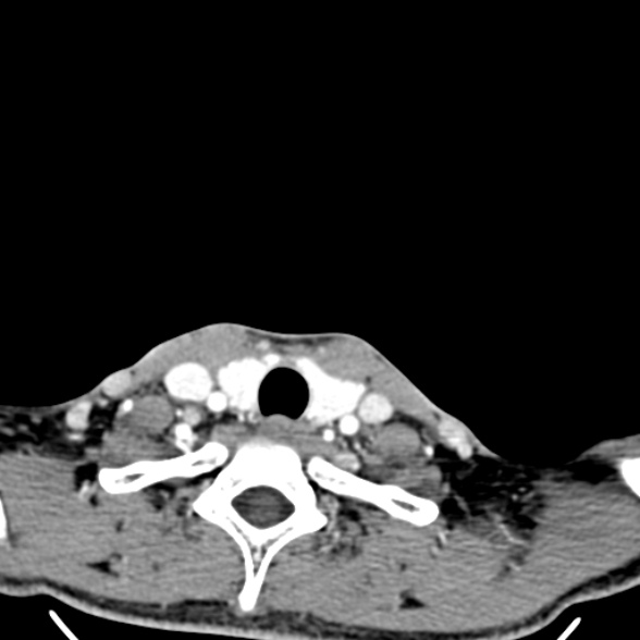 Nasopharyngeal carcinoma with skull base invasion (Radiopaedia 53415-59705 A 183).jpg
