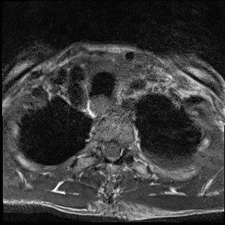 File:Nasopharyngeal carcinoma with skull base invasion (Radiopaedia 59258-66600 Axial T1 23).jpg
