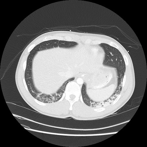 Near-drowning pulmonary edema (Radiopaedia 59457-66814 Axial lung window 48).jpg