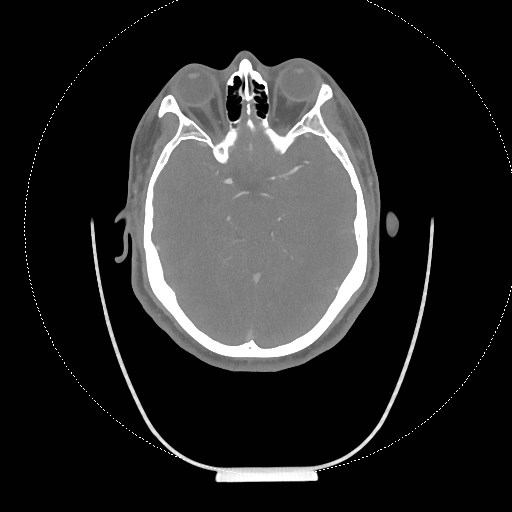 Neck CT angiogram (intraosseous vascular access) (Radiopaedia 55481-61945 B 297).jpg
