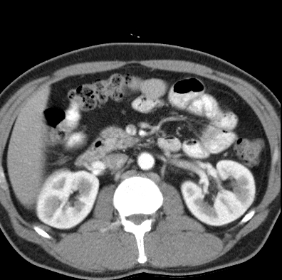 File:Necrotizing pancreatitis with acute necrotic collection (Radiopaedia 14470-14417 B 18).jpg