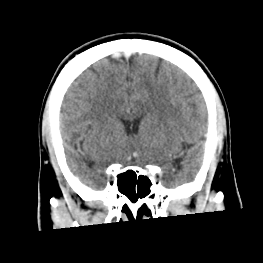 Neurocysticercosis - granular nodular (Radiopaedia 42786-45957 Coronal C+ 25).png