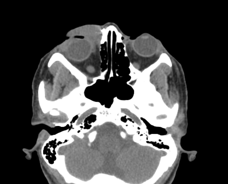 Neurofibromatosis type 1- orbital manifestations (Radiopaedia 49391-54511 Axial non-contrast 42).jpg