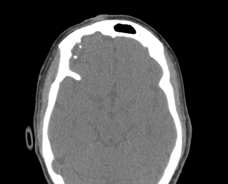 Neurofibromatosis type 1- orbital manifestations (Radiopaedia 49391-54511 Axial non-contrast 66).jpg