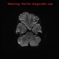 File:Neurofibromatosis type 1 with optic nerve glioma (Radiopaedia 16288-15965 Axial DWI 41).jpg