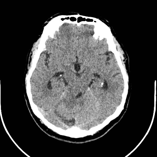 Neurofibromatosis type 2 (Radiopaedia 79097-92047 Axial non-contrast 23).jpg
