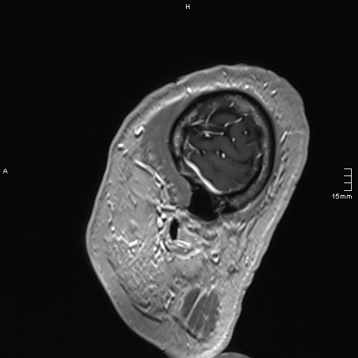 Neurosarcoidosis - involvement of the mesial temporal lobes (Radiopaedia 67429-76820 Sagittal T1 C+ 155).jpg