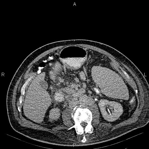 Non Hodgkin lymphoma in a patient with ankylosing spondylitis (Radiopaedia 84323-99621 Axial C+ delayed 34).jpg