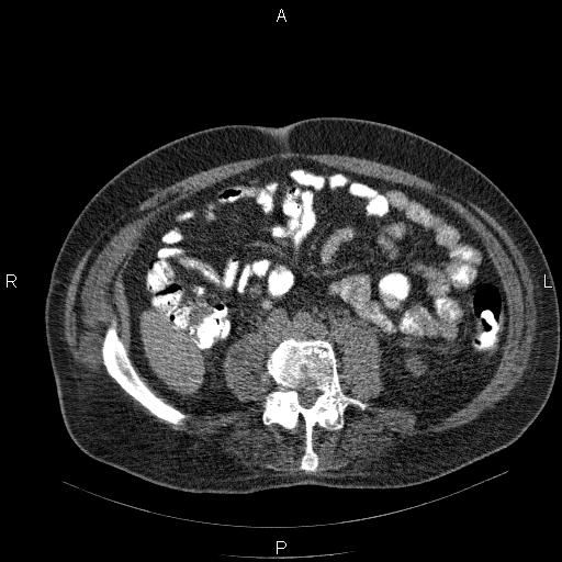 File:Non Hodgkin lymphoma in a patient with ankylosing spondylitis (Radiopaedia 84323-99624 Axial non-contrast 47).jpg