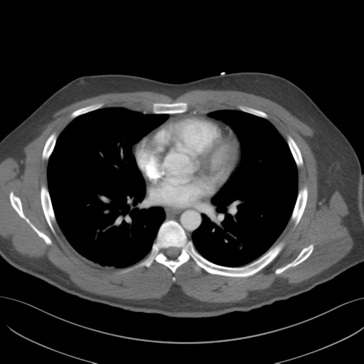 File:Normal CTA thorax (non ECG gated) (Radiopaedia 41750-44704 A 53).png