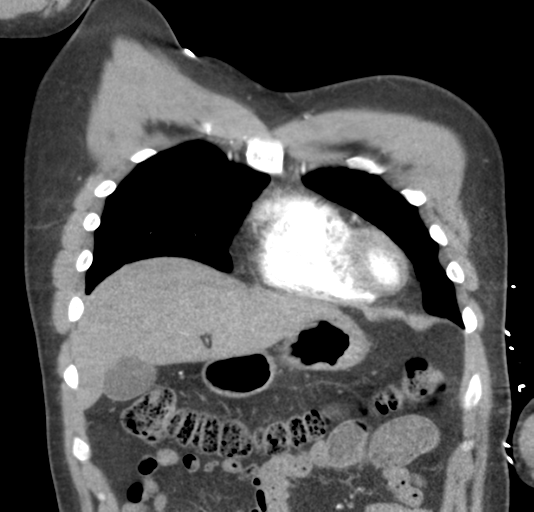 File:Normal CTA thorax (non ECG gated) (Radiopaedia 41750-44704 B 24).png