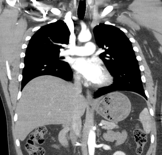 File:Normal CTA thorax (non ECG gated) (Radiopaedia 41750-44704 B 46).png