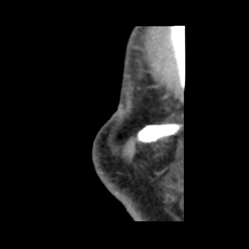 Normal CT paranasal sinuses (Radiopaedia 42286-45390 F 139).jpg