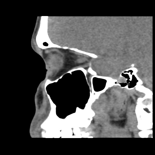 Normal CT paranasal sinuses (Radiopaedia 42286-45390 F 57).jpg