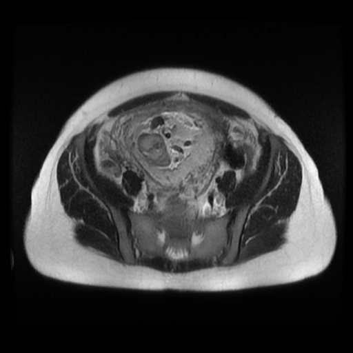 Normal MRI abdomen in pregnancy (Radiopaedia 88003-104546 Axial T2 34).jpg