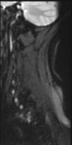 File:Normal MRI cervical spine (infection protocol) (Radiopaedia 53916-60039 Sagittal DWI 15).png