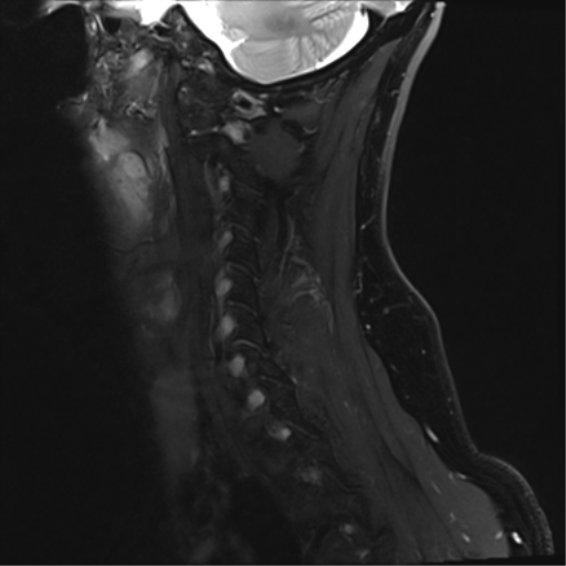 File:Normal MRI cervical spine (infection protocol) (Radiopaedia 53916-60039 Sagittal Dixon 14).png
