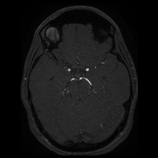 Normal brain MRA (Radiopaedia 41046-43793 Axial MRA 57).png
