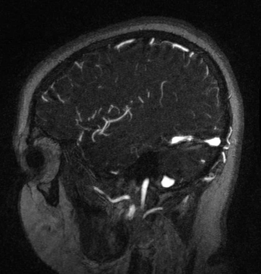 Normal brain MRI and venogram (Radiopaedia 39554-41862 Sagittal MRV 52).jpg