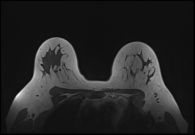 File:Normal breast MRI - dense breasts (Radiopaedia 80454-93850 Axial T1 156).jpg