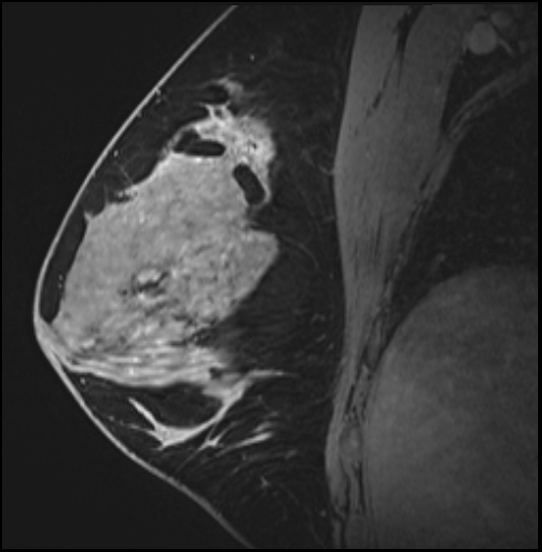 Normal breast MRI - dense breasts (Radiopaedia 80454-93850 I 92).jpg