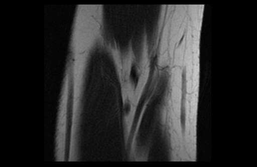 File:Normal elbow arthrograms (Radiopaedia 75550-86805 Coronal T1 17).jpg